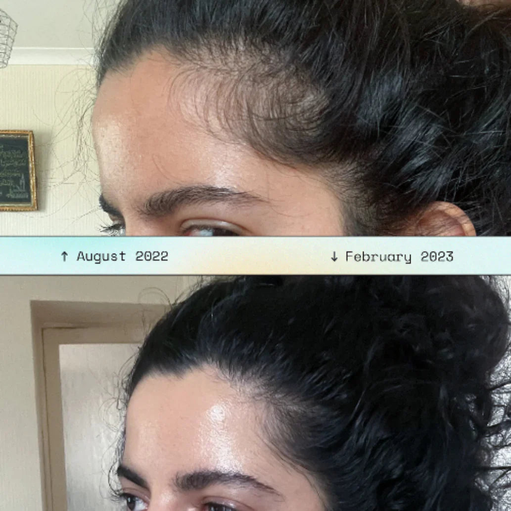 Rootsy Smart Scalp Massager for Hair Growth & Stress Relief